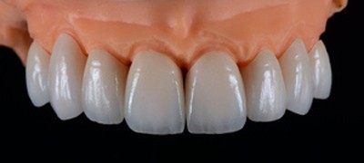 China Denture Dental lab & Zirconia Dental Crown factories