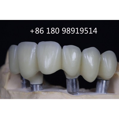 Dental Crown and Dental Bridge - Metal / Pfm / Ceramic Bridges