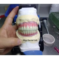 Screw-Retained Dental Implants MYY Dental Lab China